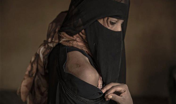 مهاجرة إثيوبية تكشف آثار الضرب الذي تعرضت له على يد مهربين احتجز